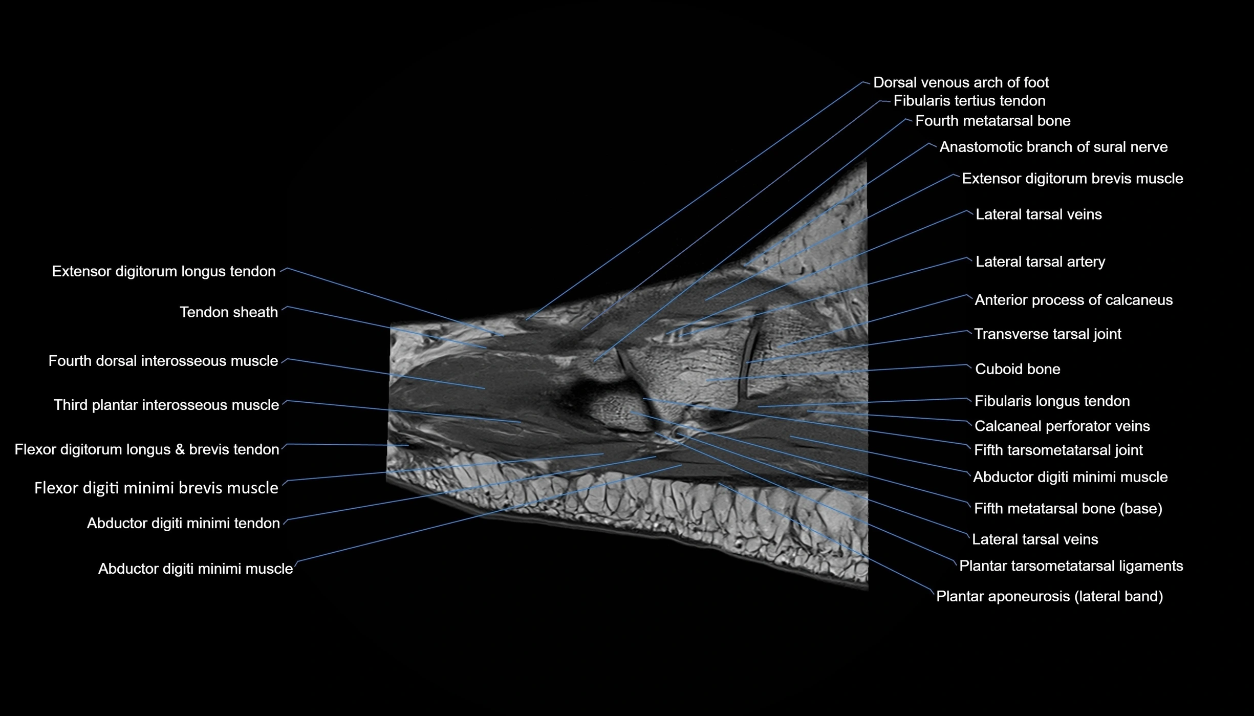 MRI mid foot sagittal cross sectional anatomy 3T  radiology  image-img-00001-00010.webp